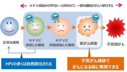 HPV感染から子宮頸がん移行までの説明図